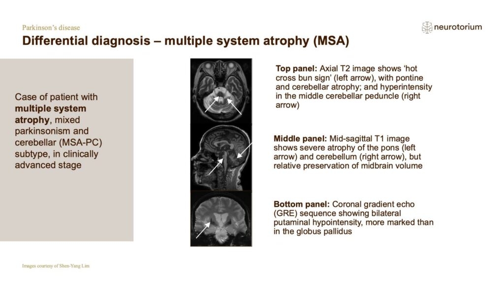 Differential diagnosis – multiple system atrophy (MSA)